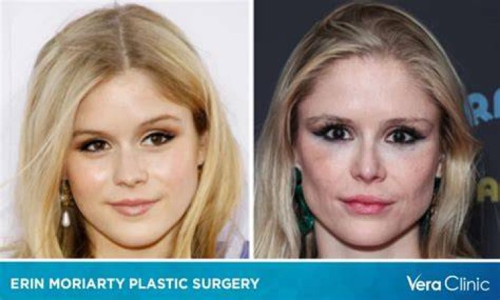 Exploring the Speculations Surrounding Erin Moriarty's Plastic Surgery